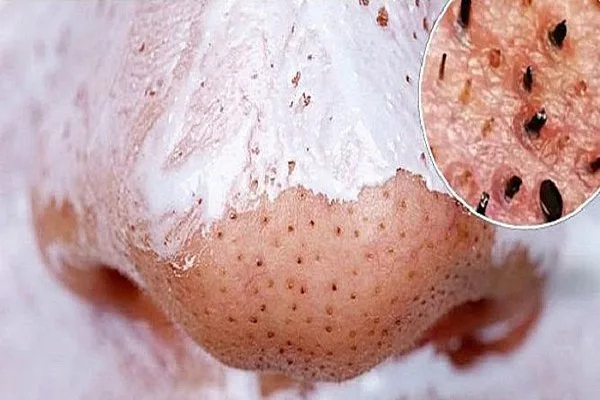 Hướng Dẫn Trị Mụn Trứng Cá, Đầu Đen Với Kem Đánh Răng