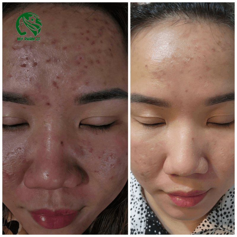 So sánh da mặt khách hàng trước và sau khi dùng kem trị mụn thâm Acne, cải thiện mụn viêm và làm sáng da.