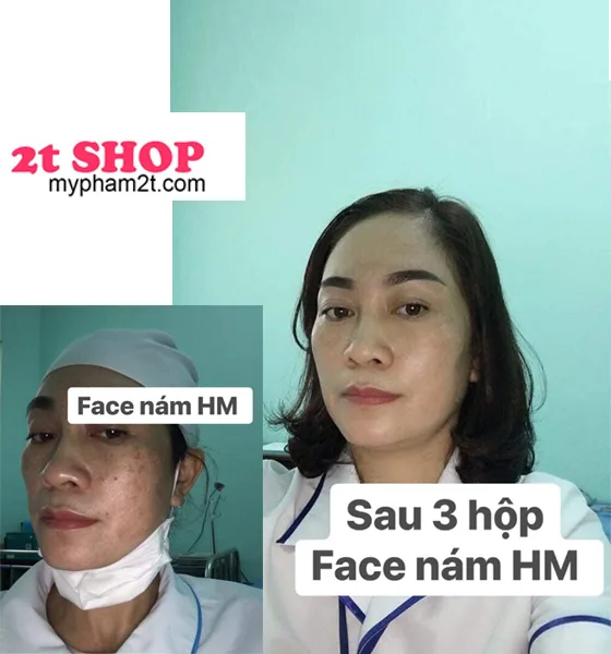 Feedback Khách Hàng Sử Dụng Kem Trị Nám Jussmy