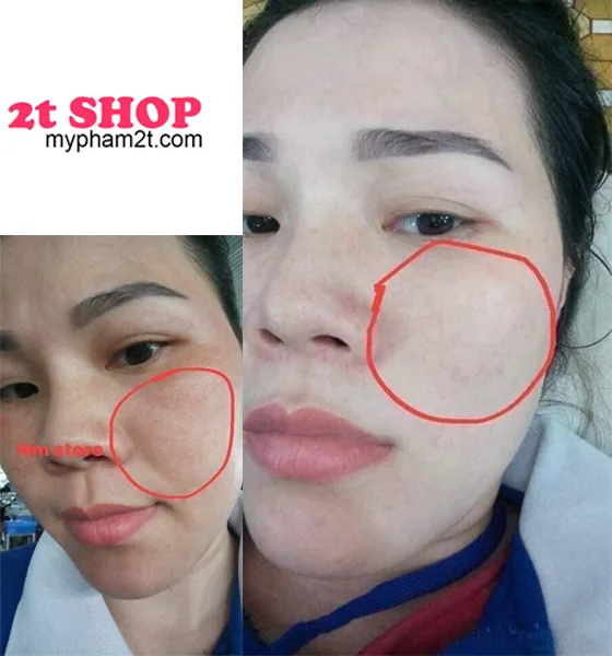 Review Kem Trị Nám Jussmy Hm Store 2Tshop