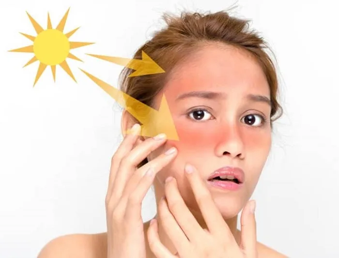 Da Dầu Có Dễ Bị Nám Hơn Da Khô Không? 2 Tia Uv Nguyên Nhân Gây Nám, Tàn Nhang