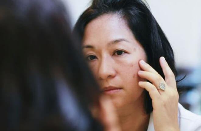 Tuổi tác, thuốc tránh thai gây nám, tàn nhang