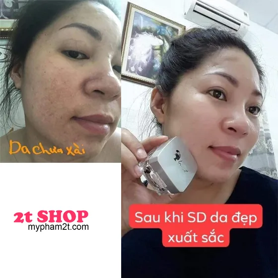 Feedback Khách Hàng Sử Dụng Kem Trị Nám Jussmy