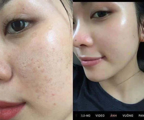 Kem Jussmy Có Tốt Không? Giá Bao Nhiêu? Review Chi Tiết &Amp; Hướng Dẫn Sử Dụng 13 Kết Quả Trước Và Sau Khi Dùng Kem Dưỡng Trắng Da Mặt Căng Bóng Jussmy Trắng Hồng Hm Store