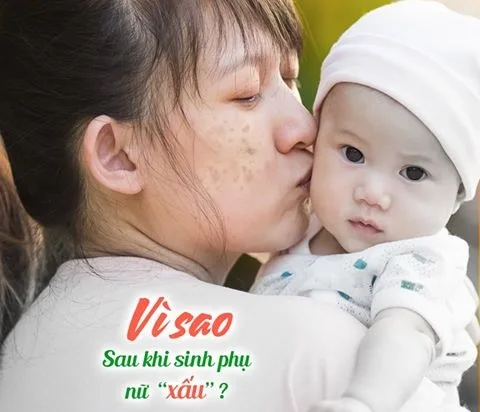 Vì Sao Da Bị Nám, Tàn Nhang Sau Sinh
