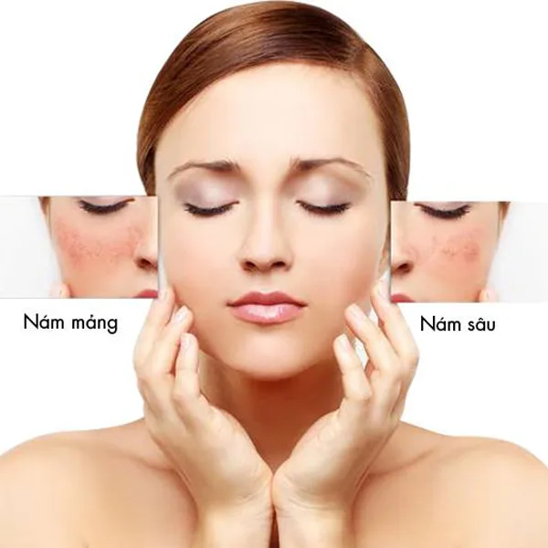 Mỹ Phẩm Trị Nám, Tàn Nhang