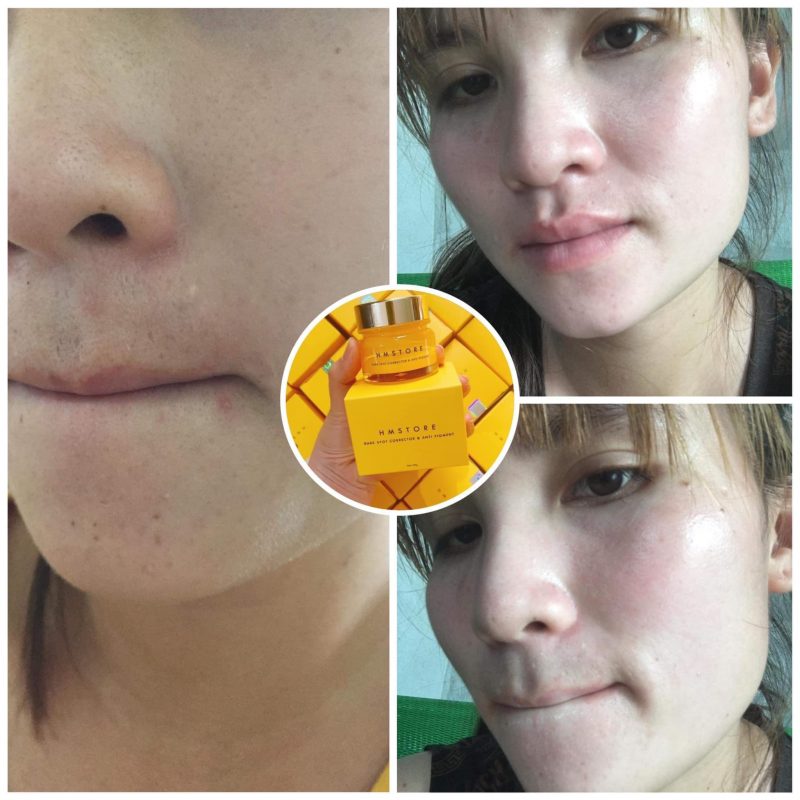 Kết Quả Làm Mờ Nám Tàn Nhang Với Kem Trị Nám Jussmy