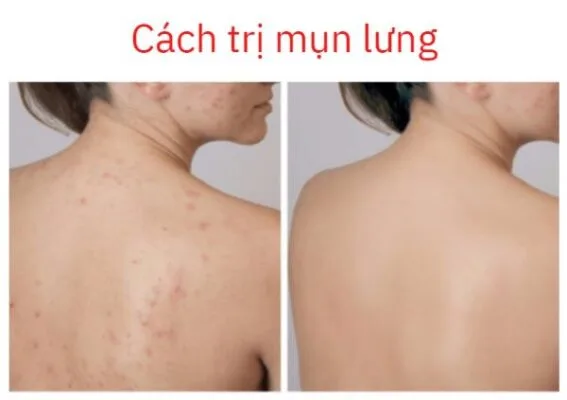 Xà Phòng Tràm Trà Dr Cell Trị Mụn Lưng, Body 8 Xà Phòng Tràm Trà Dr Cell Trị Mụn Lưng, Body 5