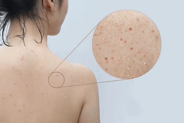 Xà Phòng Tràm Trà Dr Cell Trị Mụn Lưng, Body 7 Xà Phòng Tràm Trà Dr Cell Trị Mụn Lưng, Body 4