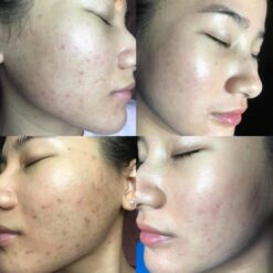 Serum Trị Mụn Heshi Acne 2 – Đặc Trị Mụn Cứng Đầu, Giảm Sưng Viêm &Amp; Mờ Thâm  Ảnh 7