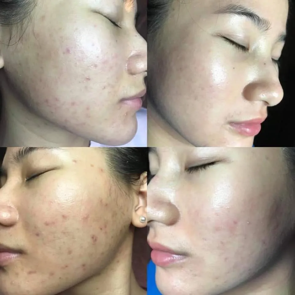 Serum Trị Mụn Heshi Acne 2 – Đặc Trị Mụn Cứng Đầu, Giảm Sưng Viêm &Amp; Mờ Thâm  Ảnh 7