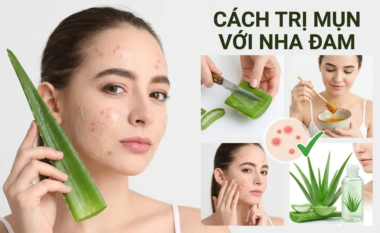 Cách Trị Mụn Bằng Nha Đam Đơn Giản Và Hiệu Quả Tại Nhà