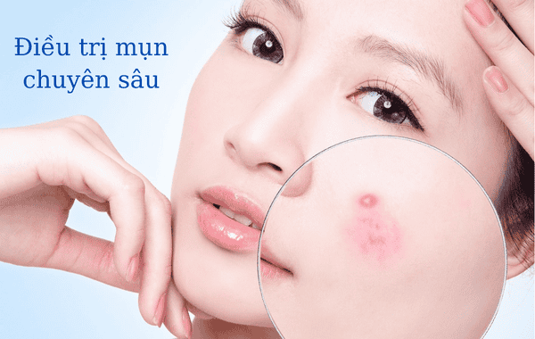 Ứng dụng glycolic trong điều trị mụn