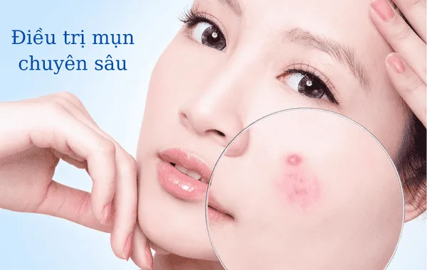 Hoạt Chất Trung Hòa Glycolic Acid Điều Trị Mụn Nám, Trẻ Hóa Da 4 Ứng Dụng Glycolic Trong Điều Trị Mụn
