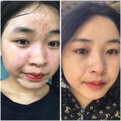 Serum Trị Mụn Heshi Acne 2 – Đặc Trị Mụn Cứng Đầu, Giảm Sưng Viêm &Amp; Mờ Thâm  Ảnh 6