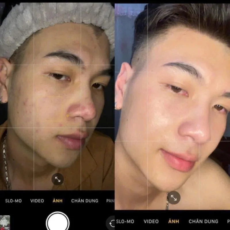 Liệu Trình Trị Mụn Chuyên Sâu Cam Kết Hiệu Quả 11 Liệu Trình Trị Mụn Chuyên Sâu Cam Kết Hiệu Quả 4