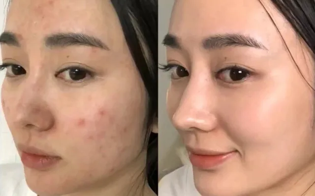 Liệu Trình Trị Mụn Chuyên Sâu Cam Kết Hiệu Quả 9 Liệu Trình Trị Mụn Chuyên Sâu Cam Kết Hiệu Quả 2