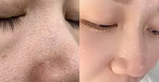 Liệu Trình Trị Mụn Chuyên Sâu Cam Kết Hiệu Quả 10 Liệu Trình Trị Mụn Chuyên Sâu Cam Kết Hiệu Quả 3