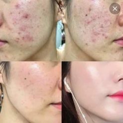 Liệu Trình Trị Mụn Chuyên Sâu