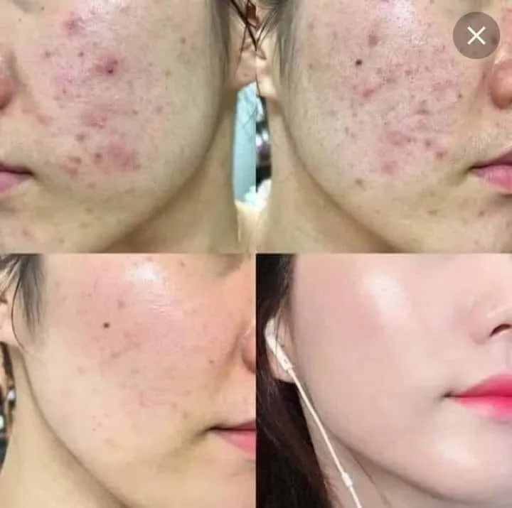 Liệu Trình Trị Mụn Chuyên Sâu