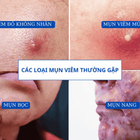 mụn viêm mụn trứng cá ở mặt, các trị mụn tại nhà hiệu quả
