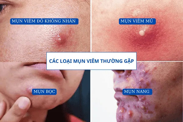 Mụn Viêm Mụn Trứng Cá Ở Mặt, Các Trị Mụn Tại Nhà Hiệu Quả