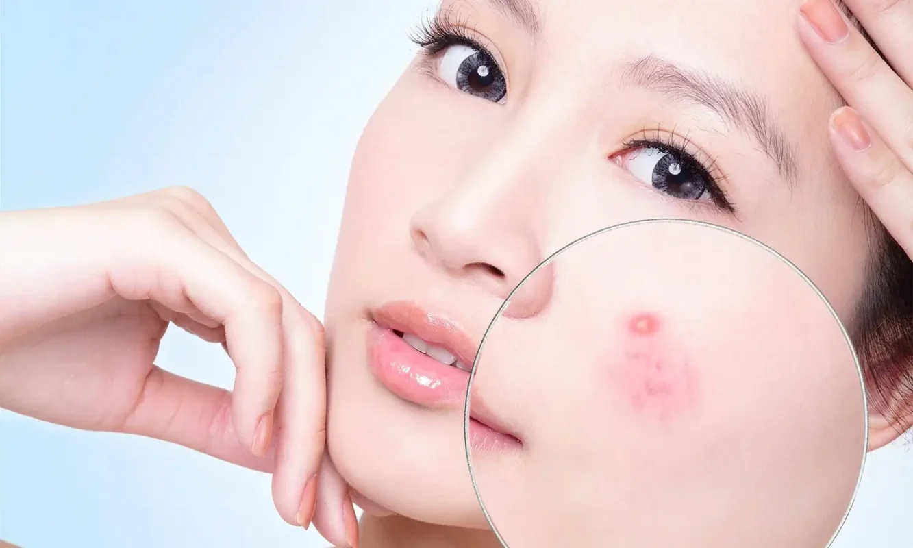 Tình Trạng Da Bị Mụn Sưng Đỏ Và Mụn Mủ Trên Da Mặt
