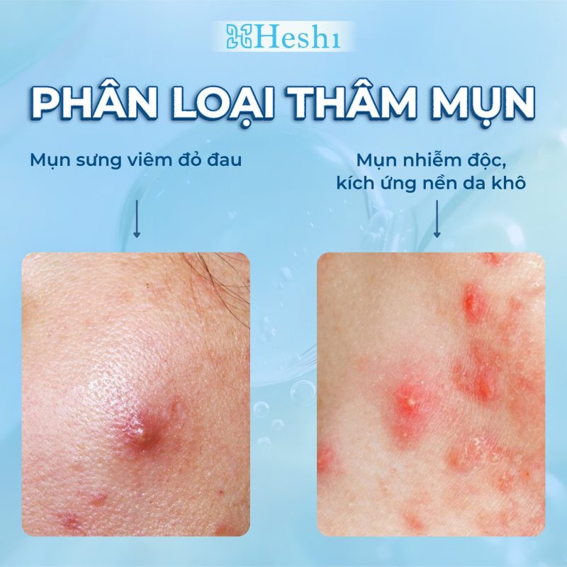 Phân loại thâm mụn