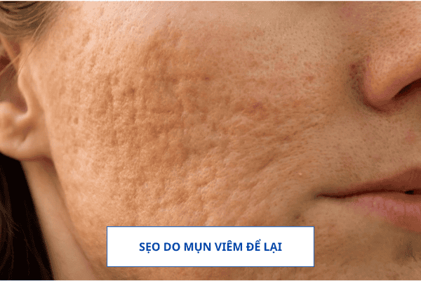 Sẹo Do Mụn Viêm Để Lại