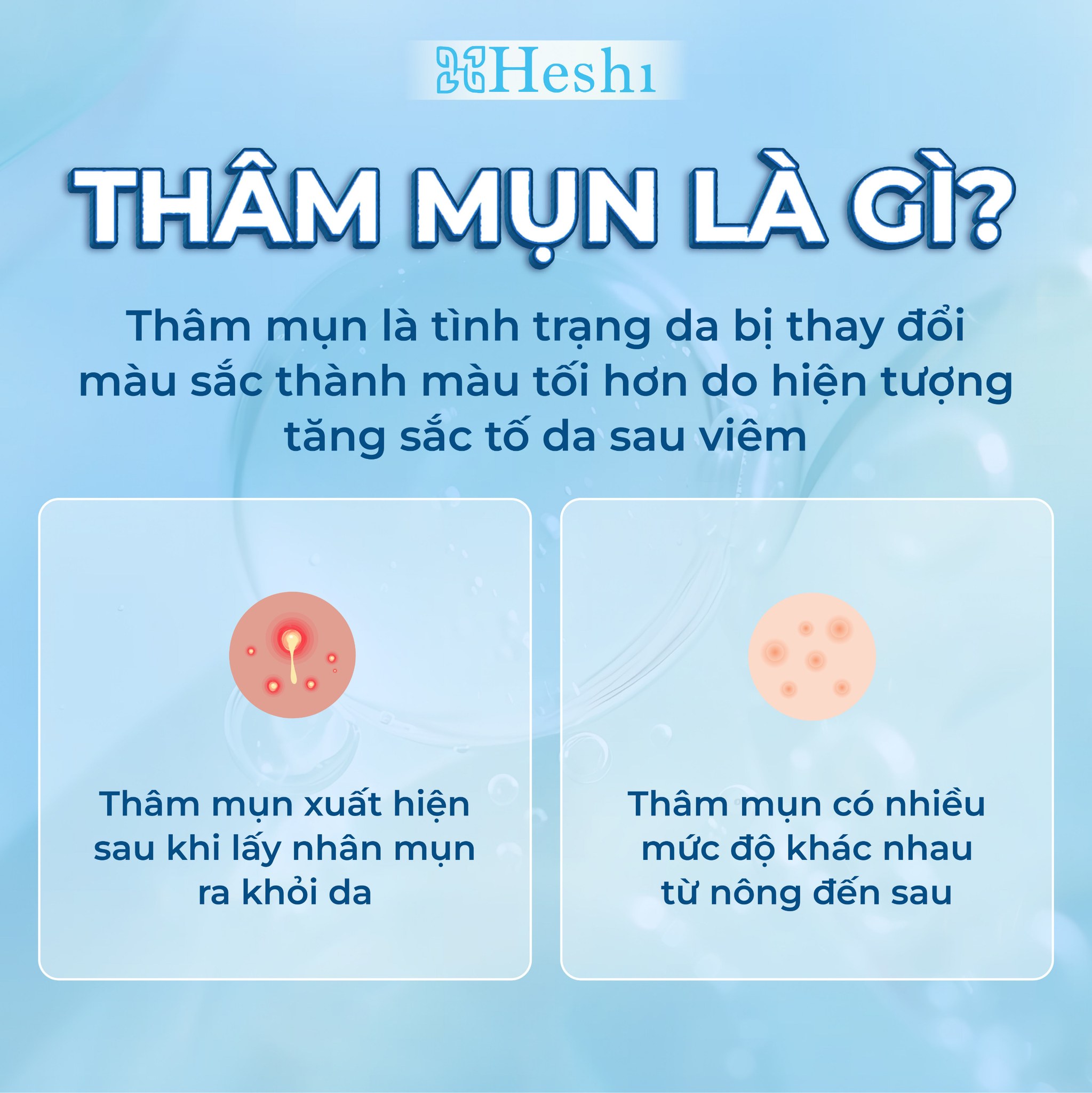 Hiểu rõ về thâm mụn
