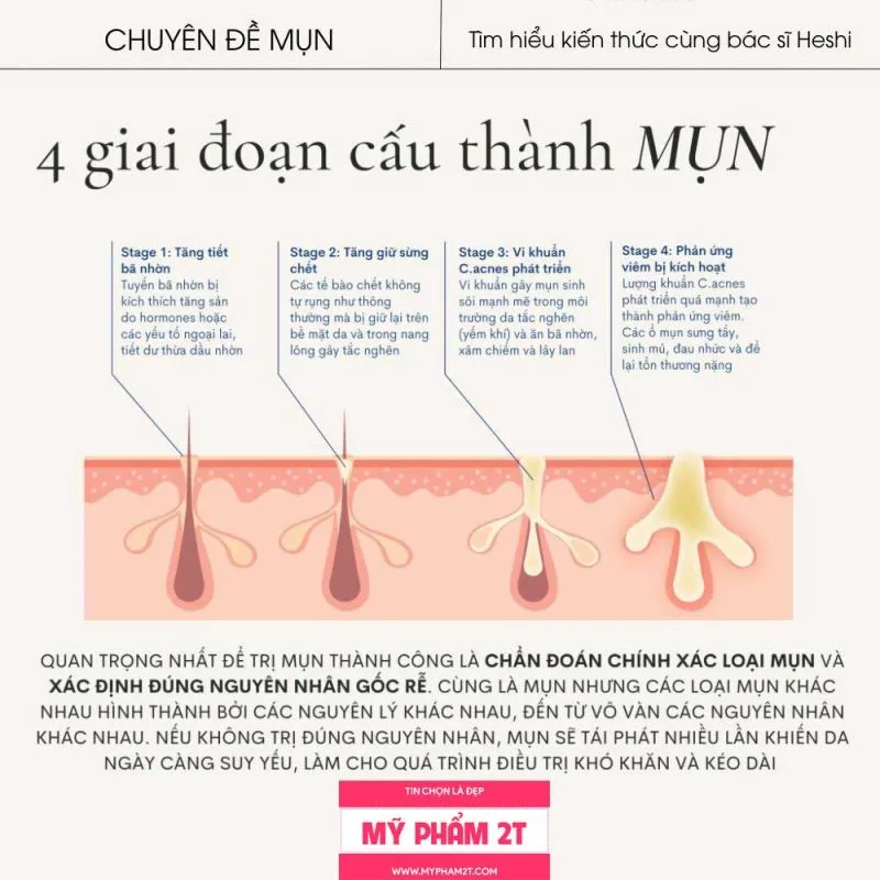 Các Giai Đoạn Hình Thành Mụn