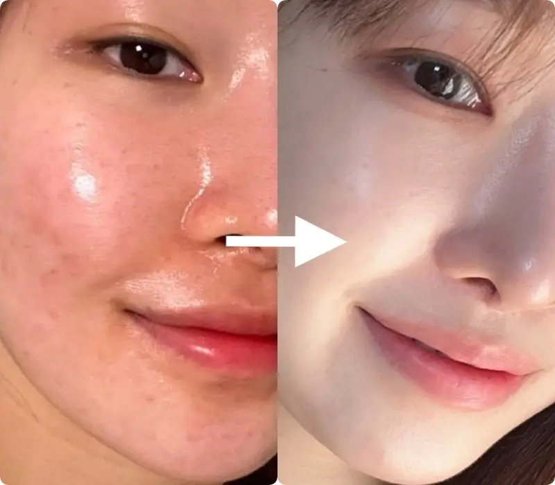 Bộ Sản Phẩm Trị Mụn Thâm Heshi Cách Giảm Mụn Da Dầu Hiệu Quả