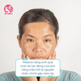 Tăng sinh melanin là nguyên nhân gây nám da