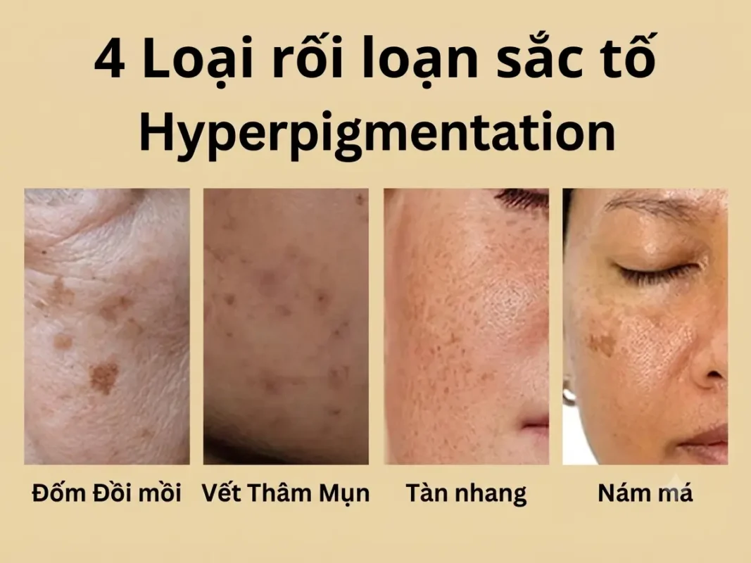 Cách Chọn Kem Trị Nám Phù Hợp – Gợi Ý Sản Phẩm Hiệu Quả Chuẩn Y Khoa 2 4 Loại Rối Loạn Sắc Tố Hyperpigmentation: Đốm Đồi Mồi, Vết Thâm Mụn, Tàn Nhang Và Nám Má – Hình Ảnh Minh Họa Rõ Nét