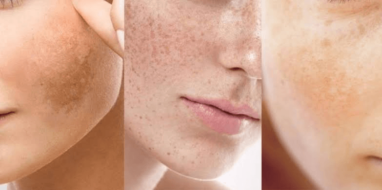 Cách Chọn Kem Trị Nám Phù Hợp – Gợi Ý Sản Phẩm Hiệu Quả Chuẩn Y Khoa 1 Hình Ảnh Minh Họa Các Loại Rối Loạn Sắc Tố Da: Nám Má, Tàn Nhang Và Đốm Nâu Trên Da Mặt
