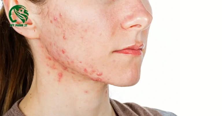 Da Nhiễm Corticoid Biểu Hiện Và Cách Thải Độc Corticoid