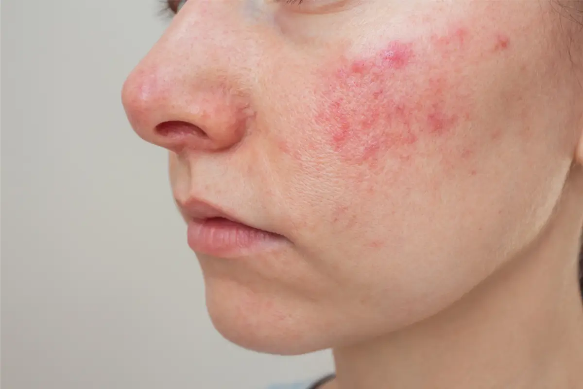 Biểu Hiện Da Nhiễm Corticoid: Má Đỏ, Da Mỏng, Dễ Ửng