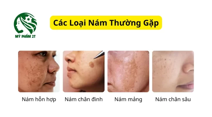 Các Loại Nám Phổ Biến Thường Gặp