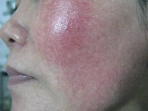 Da Bị Giãn Mao Mạch Khi Bị Nhiễm Corticoid