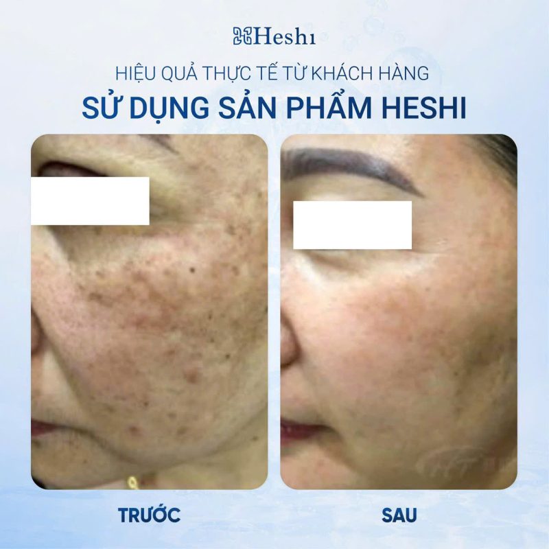 Dược mỹ phẩm heshi trị nám da