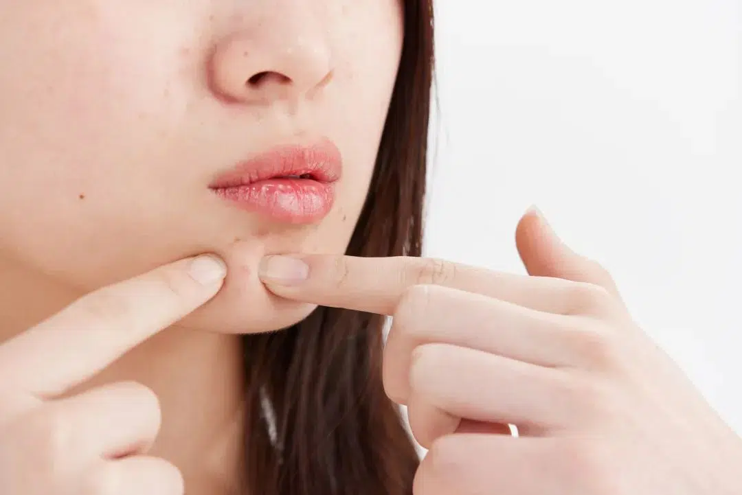 Làm Sao Để Điều Trị Mụn Tại Nhà