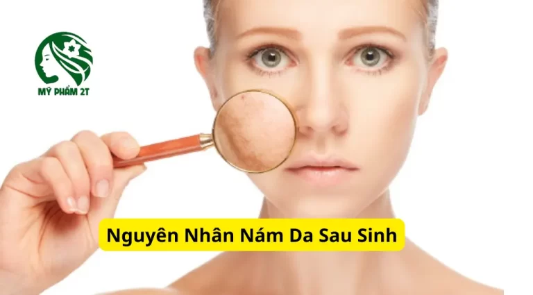 Nám Da Sau Sinh Nguyên Nhân Và Cách Khắc Phục