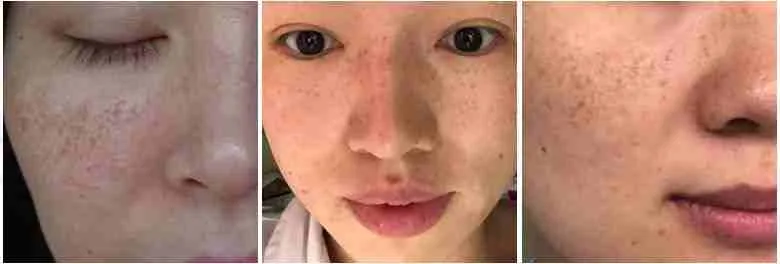 Da Dầu Có Dễ Bị Nám Hơn Da Khô Không? 4 Da Khô Bị Nám