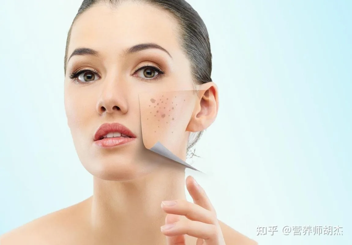 Nám Da Là Gì? Nguyên Nhân Và Phân Loại Chi Tiết 1 Nguyên Nhân Gây Nám Da Nám Da Là Gì