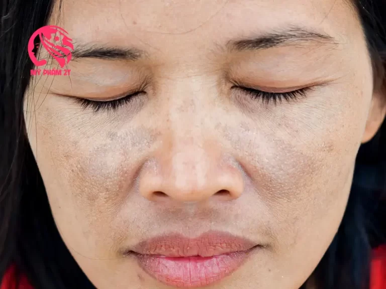 Nám Da Là Gì? Nguyên Nhân Và Phân Loại Chi Tiết