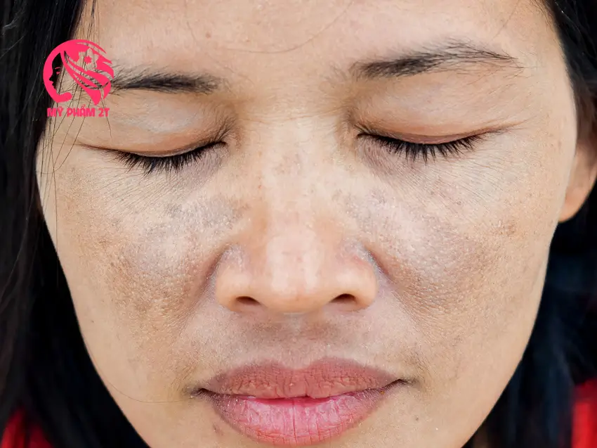 thành phần trị nám có trong mỹ phẩm