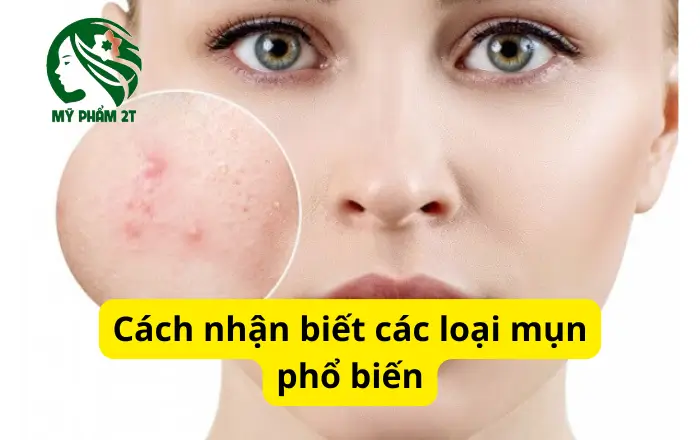 Các Loại Mụn Phổ Biến Và Cách Nhận Biết