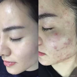 Kem Trị Mụn Thâm Acne – Giảm Mụn, Mờ Thâm Hiệu Quả 10 Kem Trị Mụn Thâm Acne – Giảm Mụn, Mờ Thâm Hiệu Quả Ảnh 4