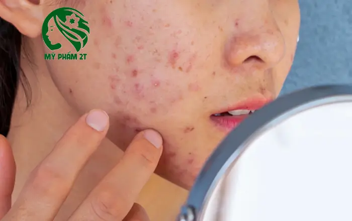 da mụn bị tổn thương