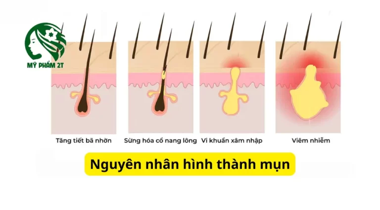 Da Mụn Là Gì? 5 Nguyên Nhân Hình Thành Mụn Bạn Cần Biết Sớm